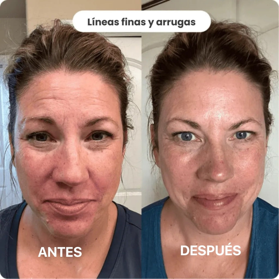 BioInfusion Aura | Sistema de Micro Infusión