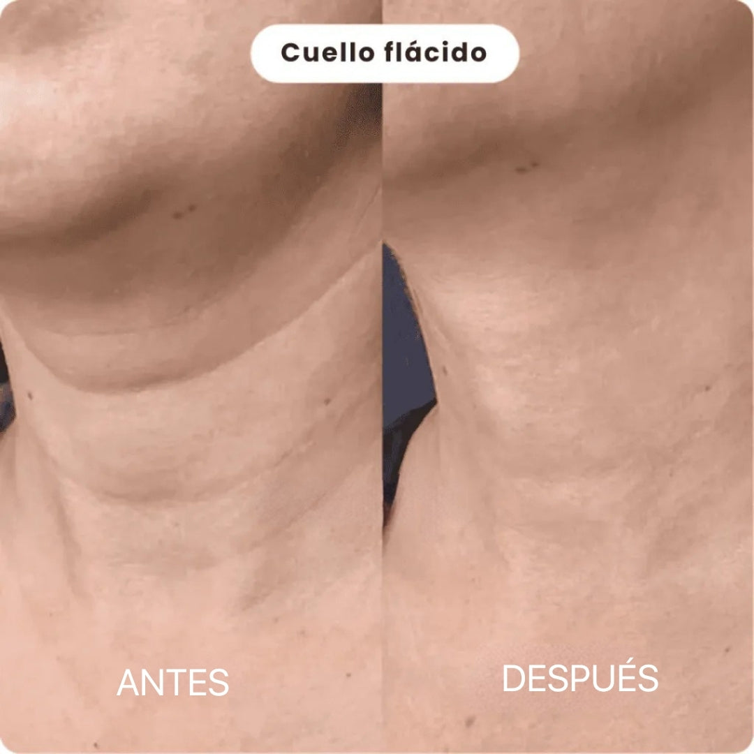 Sistema de Micro Infusión | BioInfusion Aura™