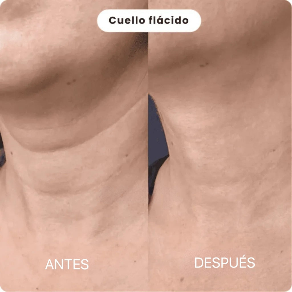 Sistema de Micro Infusión | BioInfusion Aura