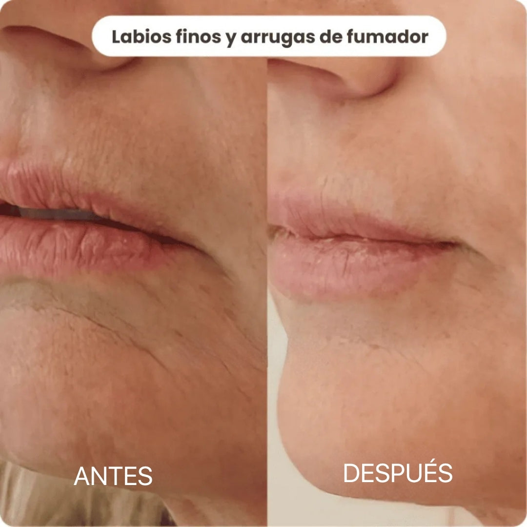Sistema de Micro Infusión | BioInfusion Aura™
