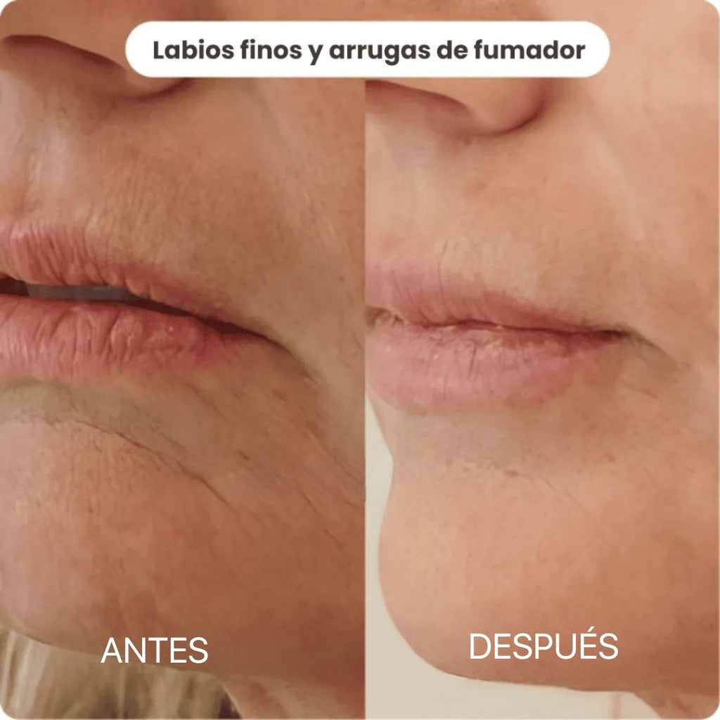 Sistema de Micro Infusión | BioInfusion Aura